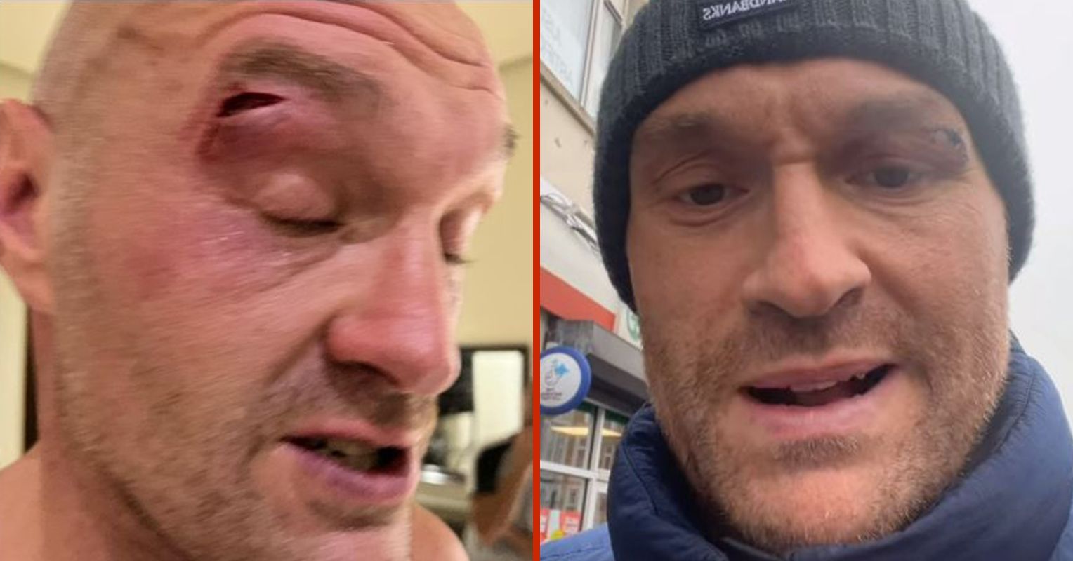 Tyson Furys Sparring Partner Explains He Cut Brit After Prank Backfired